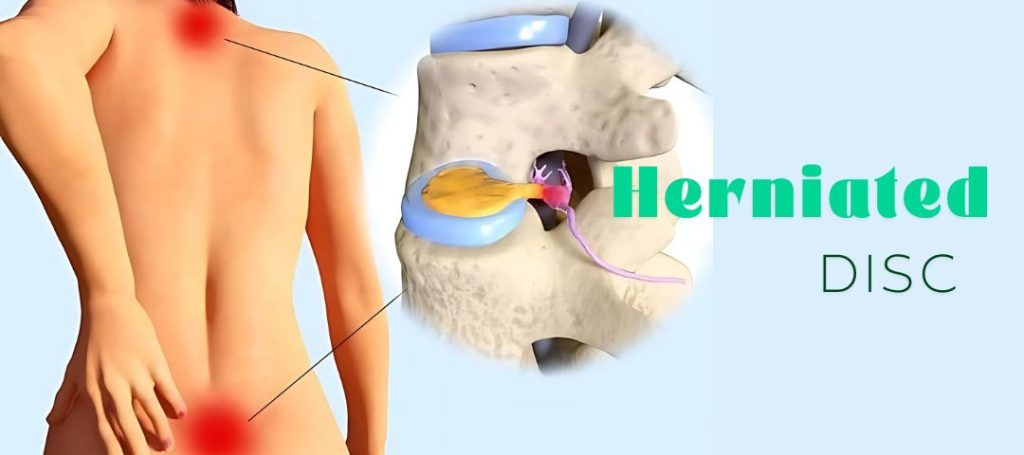 herniated-disc